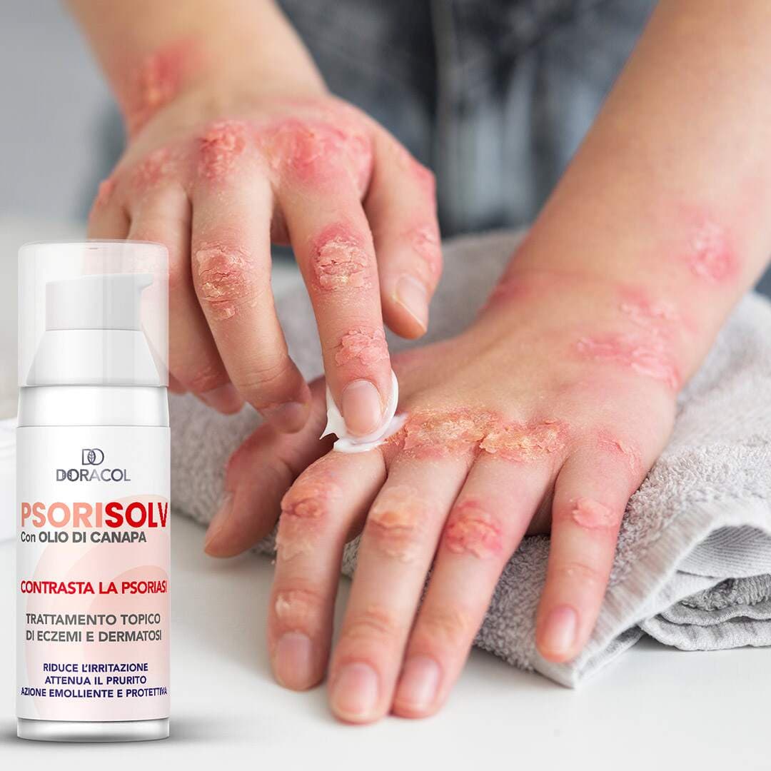 Sorisolv - Psoriasis Cream | Crema per psoriasi che riduce il prurito