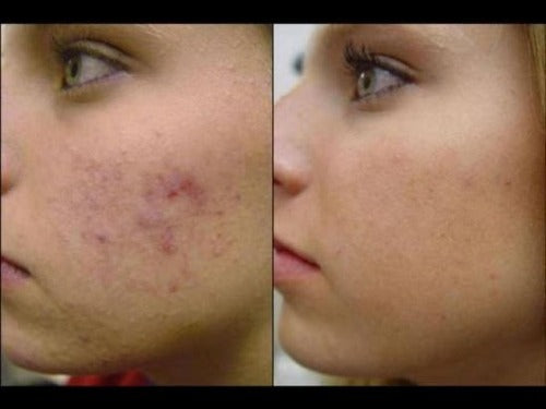 Antiacne