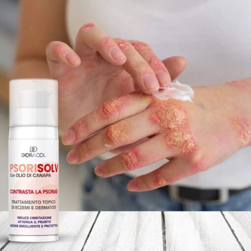 Sorisolv - Psoriasis Cream | Crema per psoriasi che riduce il prurito